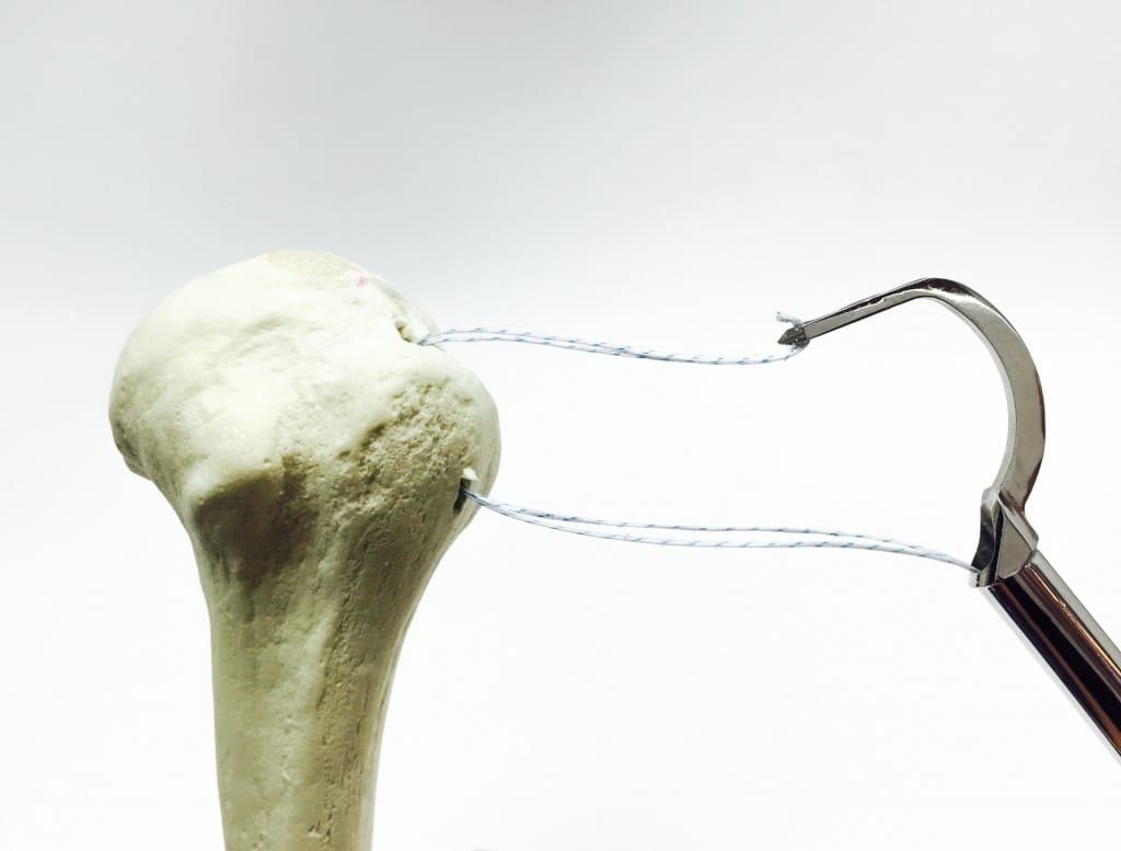 Strength and Outcomes Equivalent<br> to Double Row Anchor Repair TransOS Tunneler:Orthopedic spine,Flat arthroscopy,Orthopedic surgery instrument